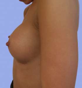 Implant Mamar Postoperator