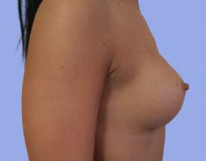 Implant Mamar Postoperator