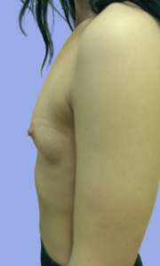 Implant Mamar Preoperator