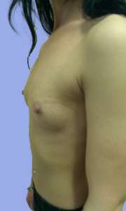 Implant Mamar Preoperator