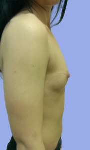 Implant Mamar Preoperator