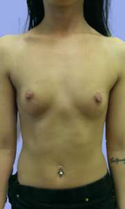 Implant Mamar Preoperator