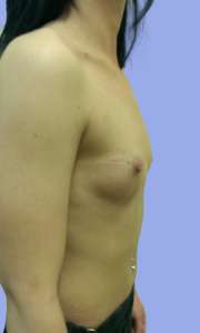 Implant Mamar Preoperator